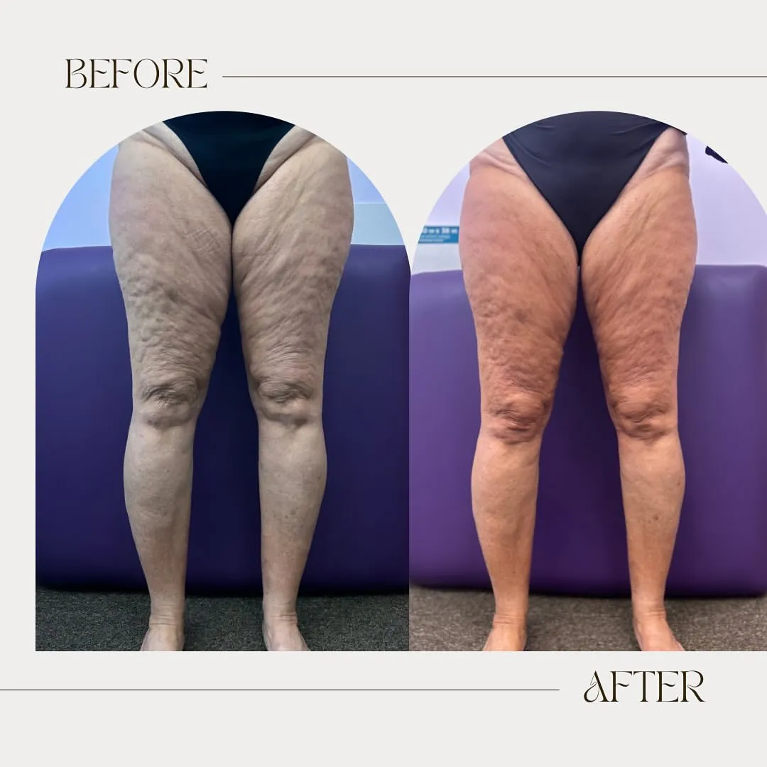 Cellulite Appearance