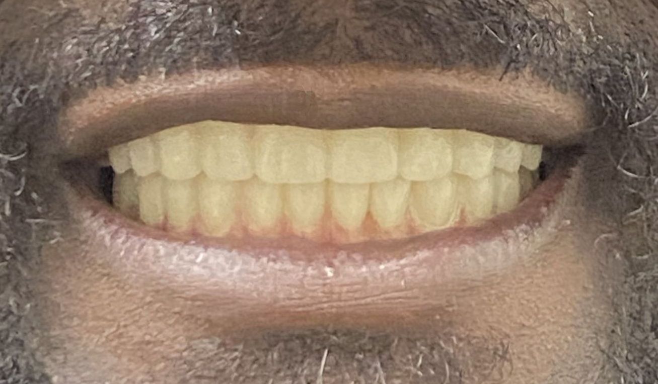 After smile transformation 4