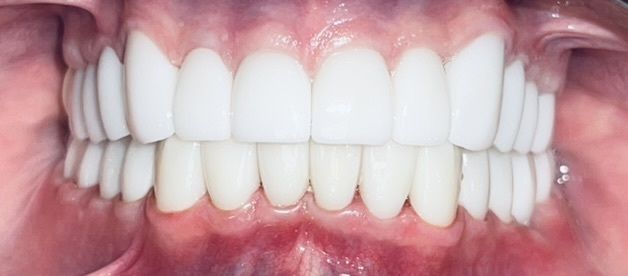 After smile transformation 1