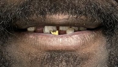 Before smile transformation 4