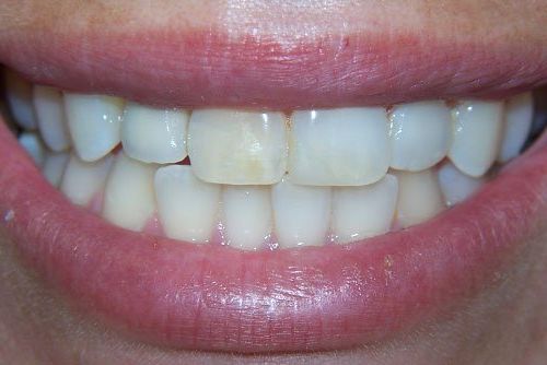 After smile transformation 3