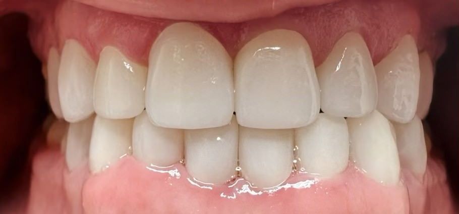 After smile transformation 2