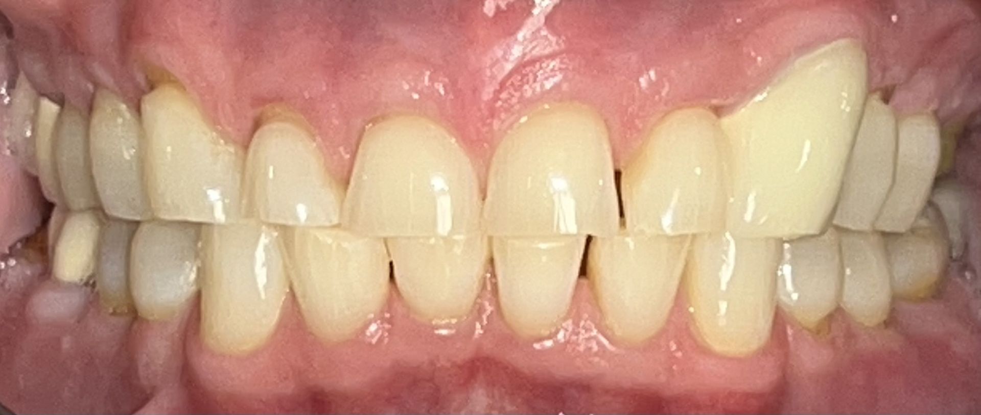 Before smile transformation 1