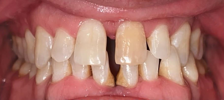 Before smile transformation 2