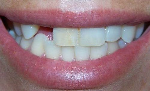Before smile transformation 3