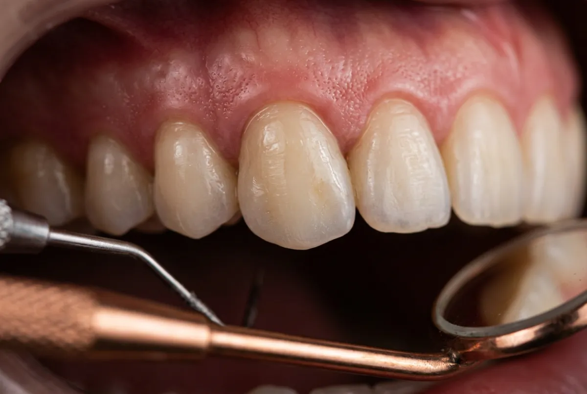 Detailed view of porcelain crown margins and restorative precision check