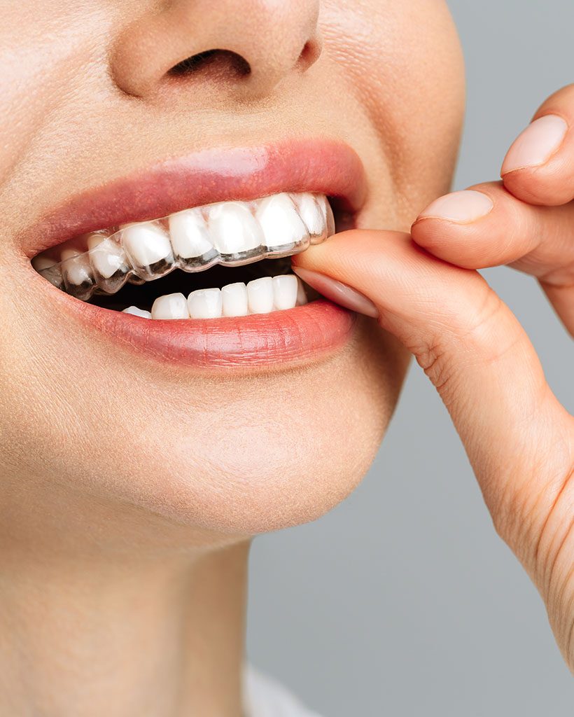 Woman pointing to her Invisalign clear aligner