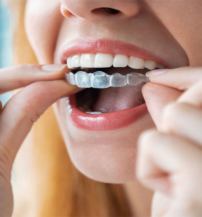 Invisalign treatment