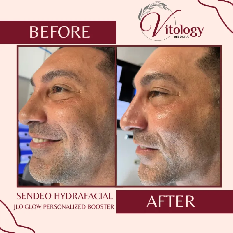 Sendeo Hydrafacial JLo Glow Personalized Booster