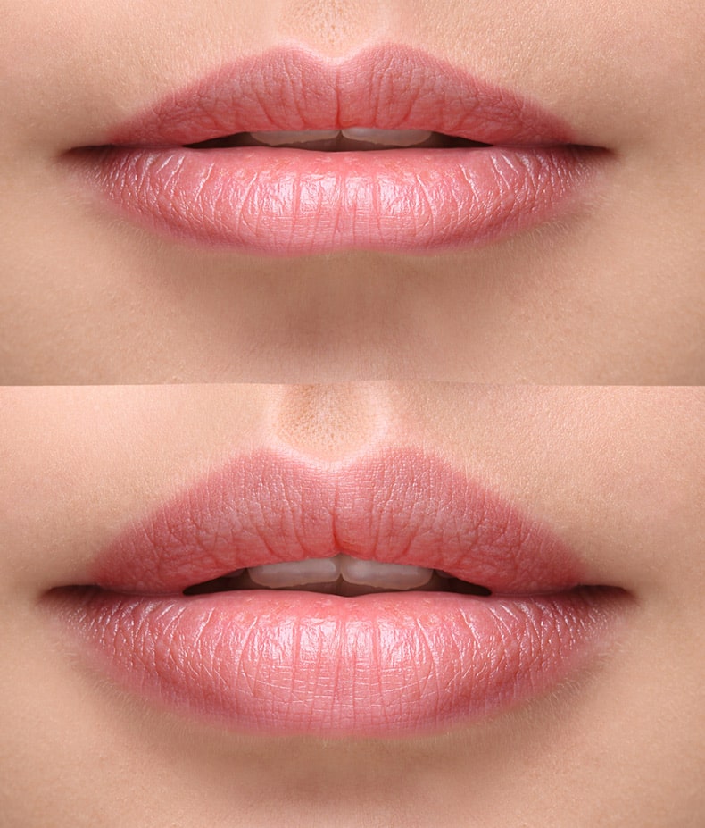 Lips Before and After