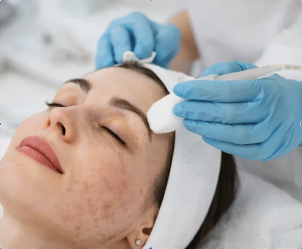 VI Peel Treatment