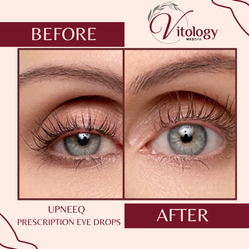 Eyes before and after