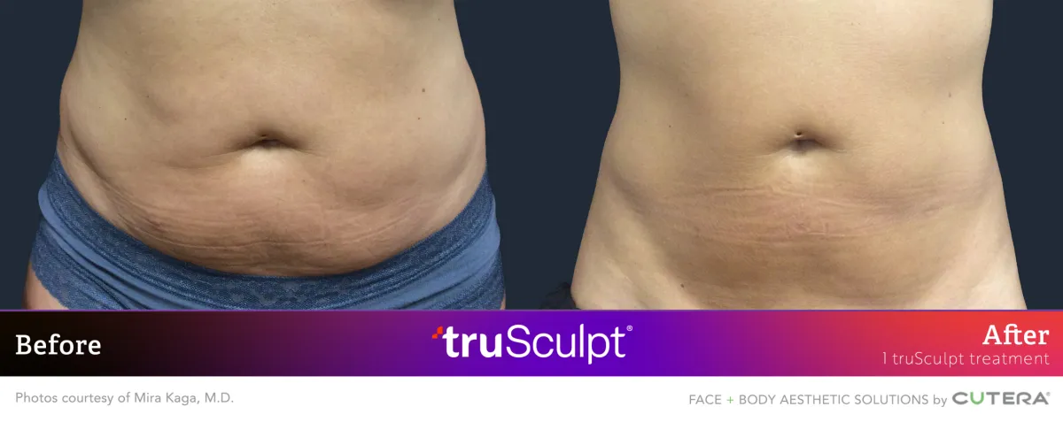 Before and after images showcasing truSculpt body sculpting treatment results.