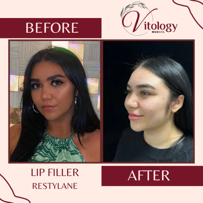 Lips before and after