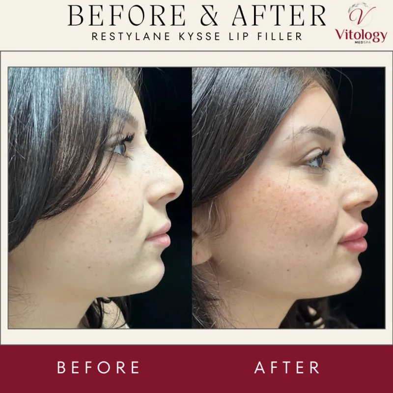 Lips before and after