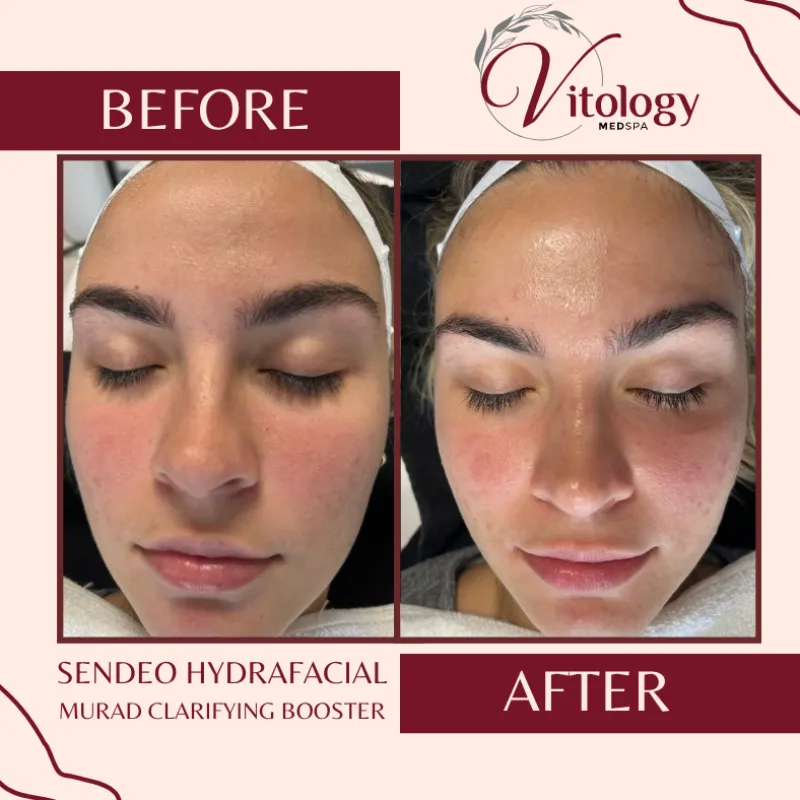Sendeo Hydrafacial Murad Clarifying Booster