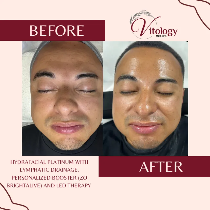 Hydrafacial Platinum With Lymphatic Drainage