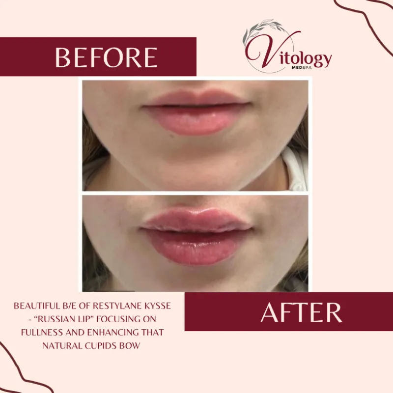 Lips before and after