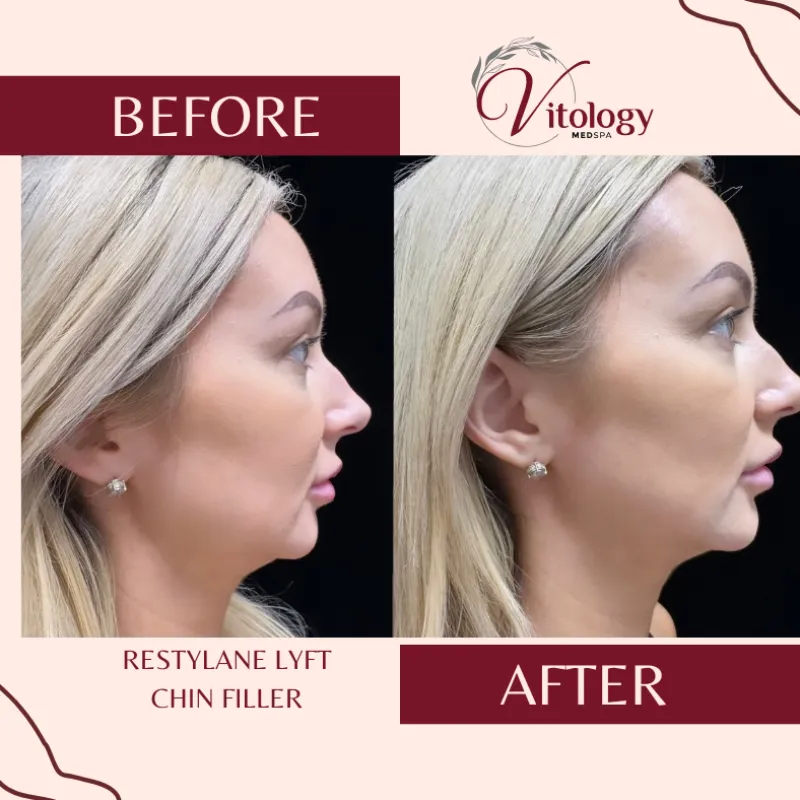 Chin Before and After
