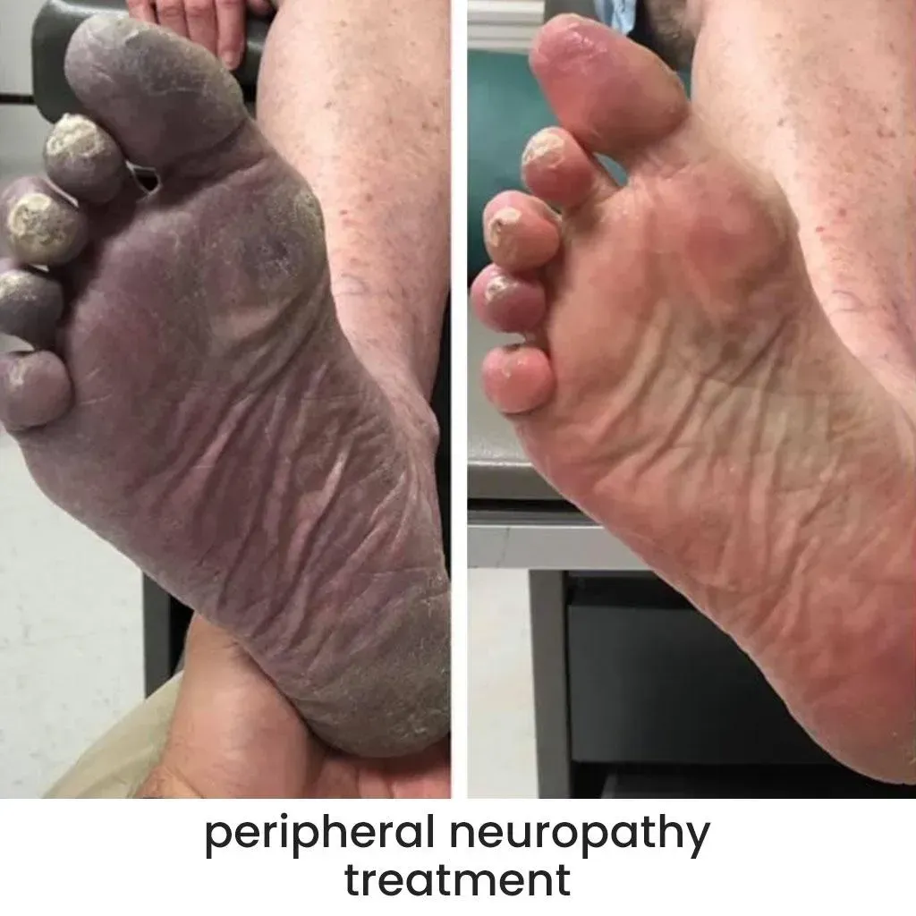 Peripheral neuropathy treatment