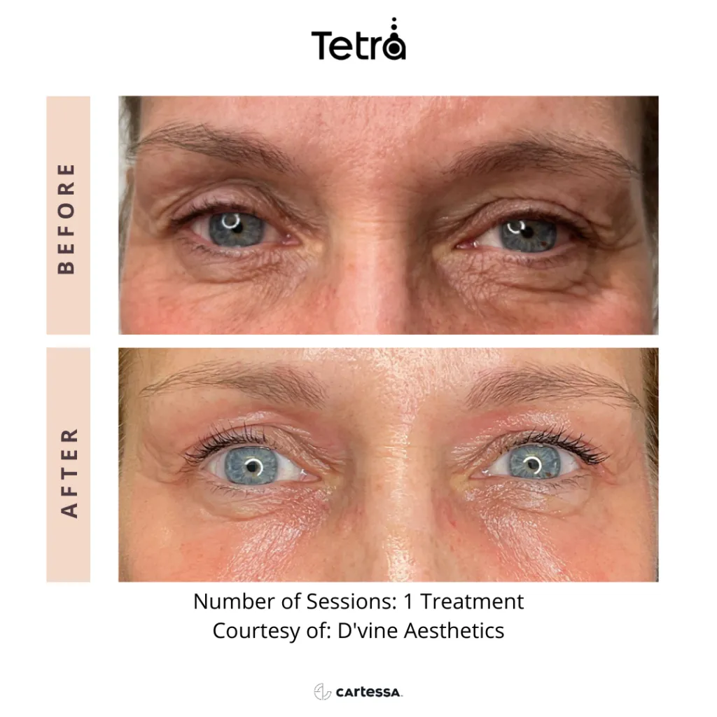 Tetra Before and After Eyes