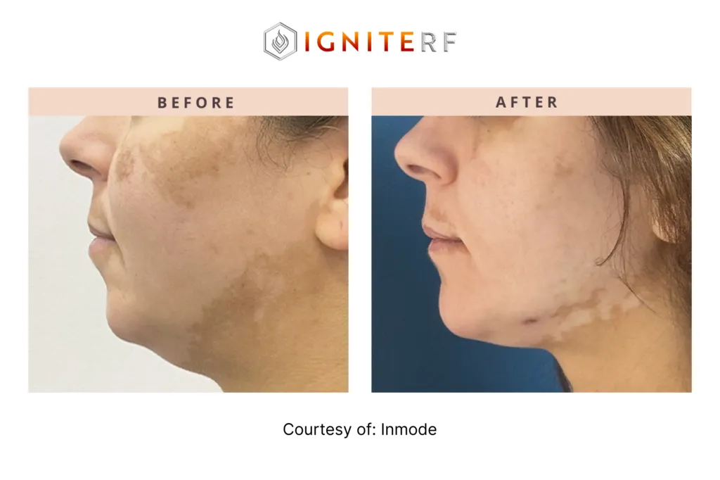 Before and After Lower Face