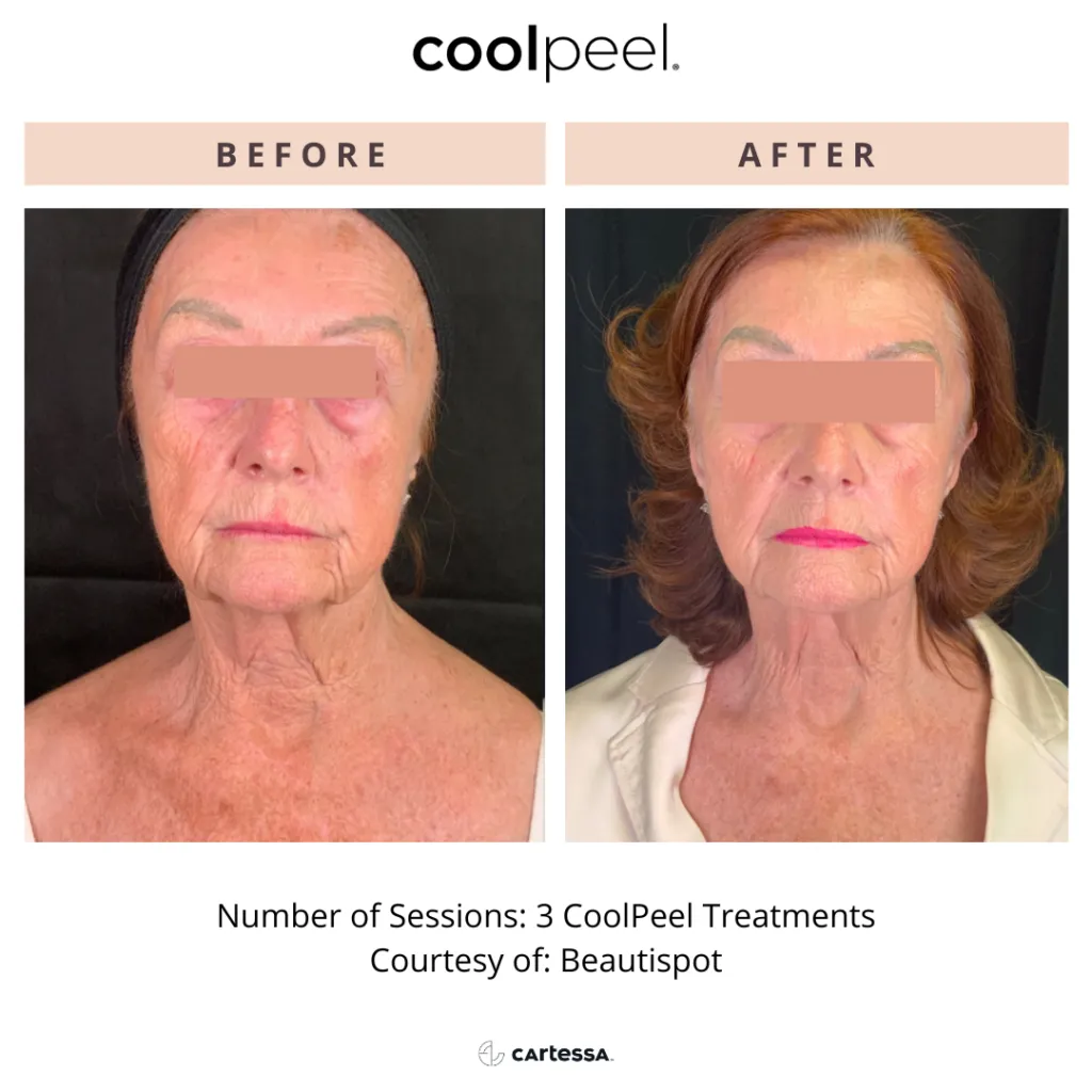 CoolPeel Before and After Neck