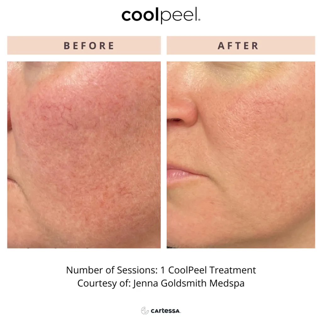 CoolPeel Before and After Face