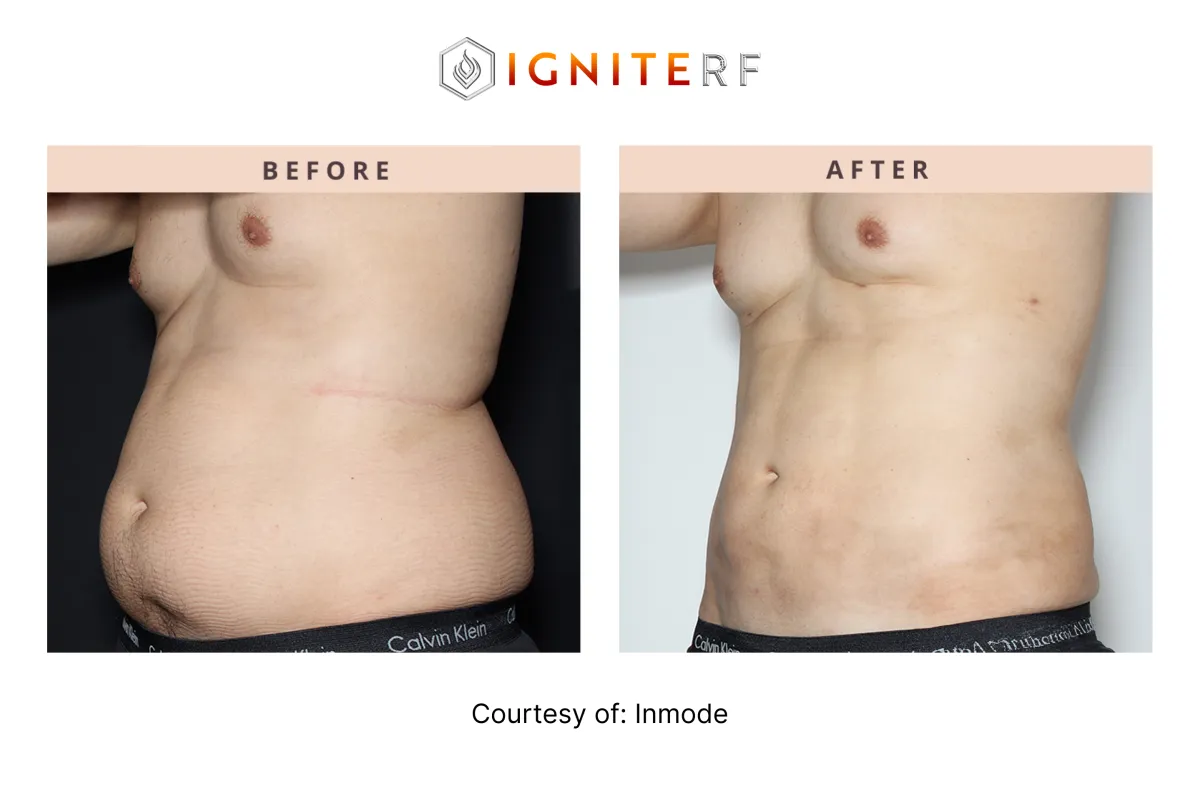 Before and After Abdomen