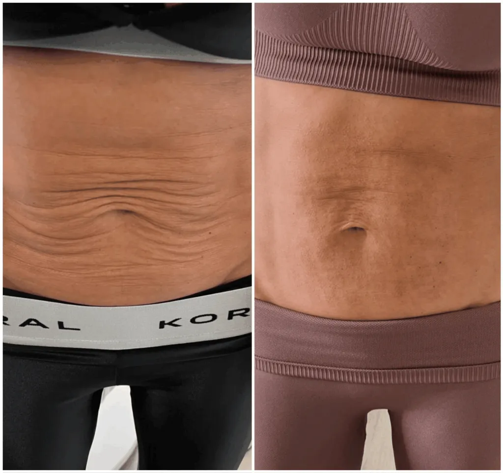 Morpheus8 Abdomen before after