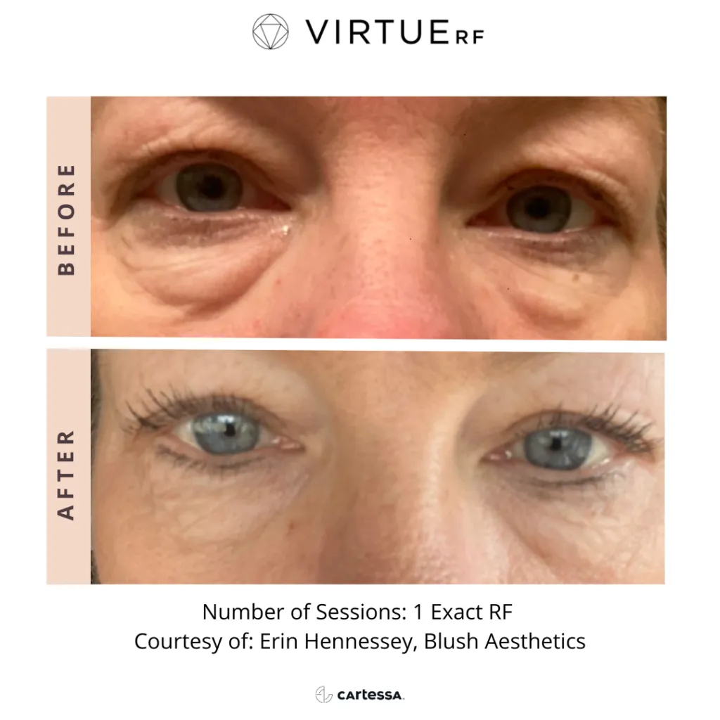 Virtue RF before and after eyes
