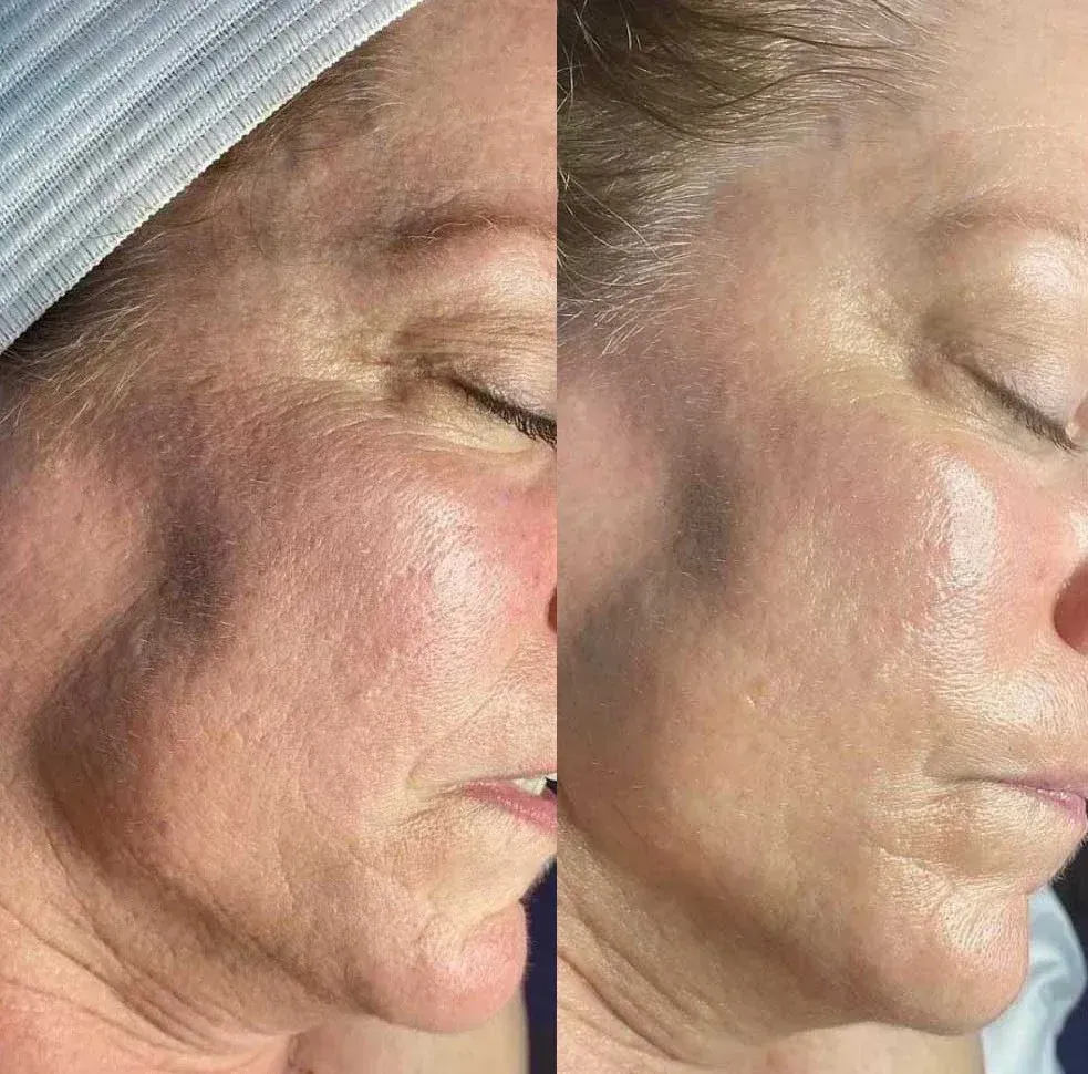Hydrafacial Before and After 2