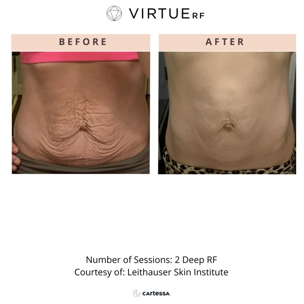 Virtue RF before and after face