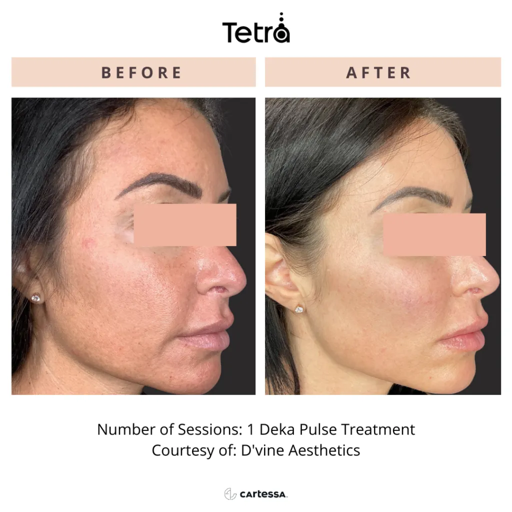 Before and After face treatment