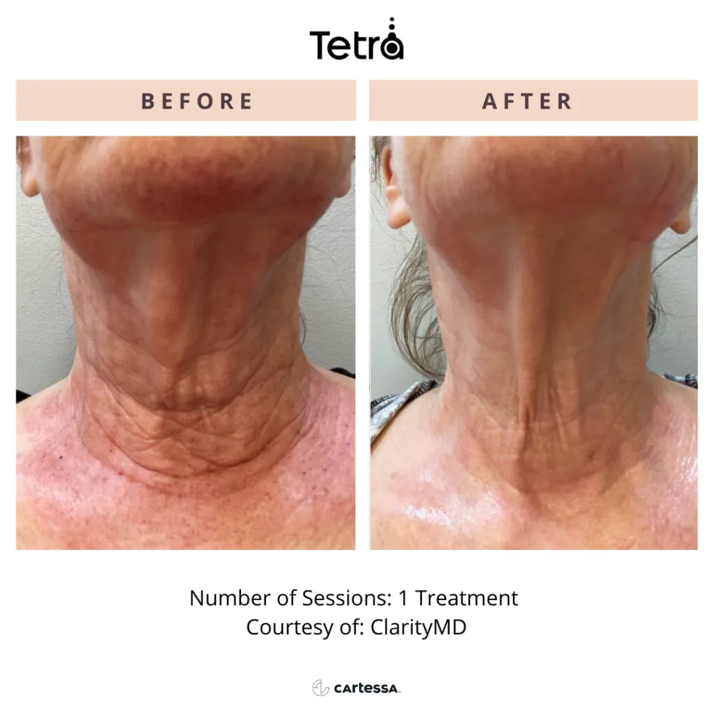 Before and After neck treatment