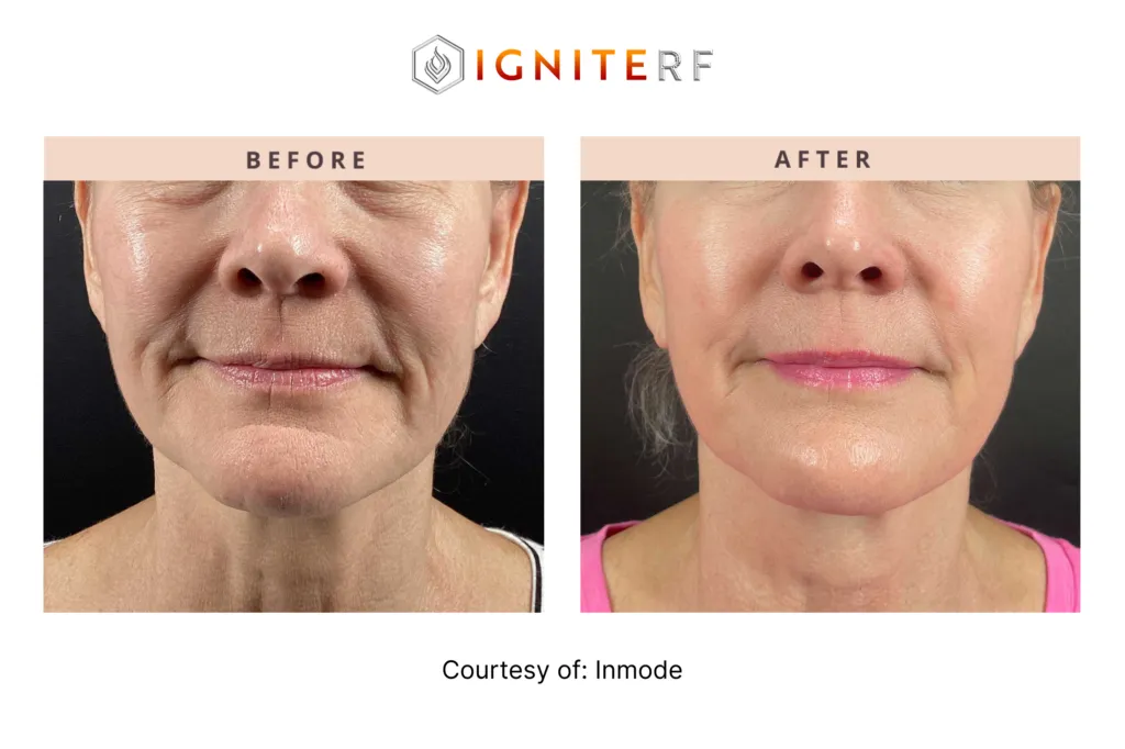 Before and After Full Face