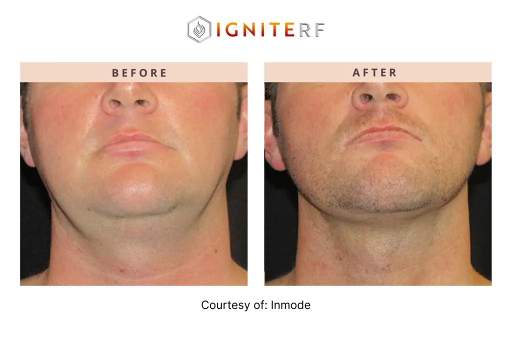 Before and After Jawline