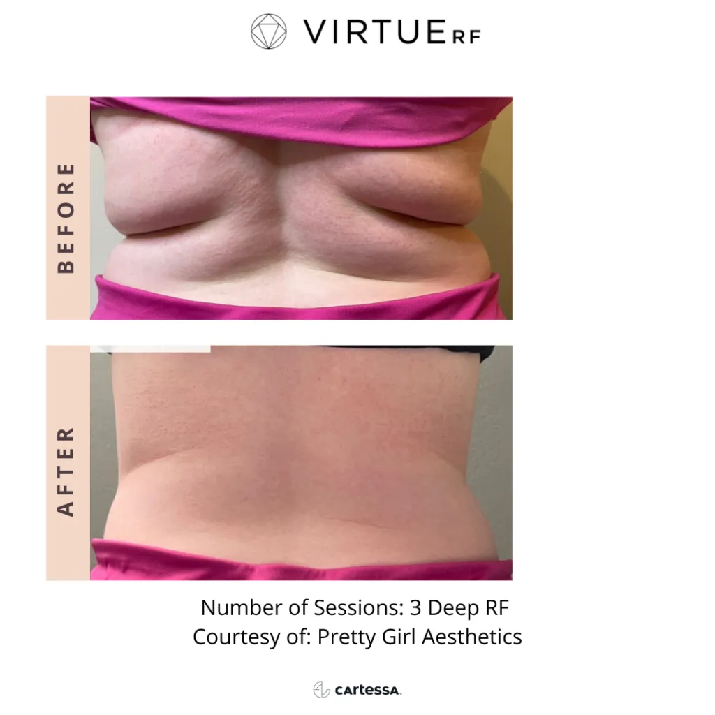 Virtue RF before and after stomach