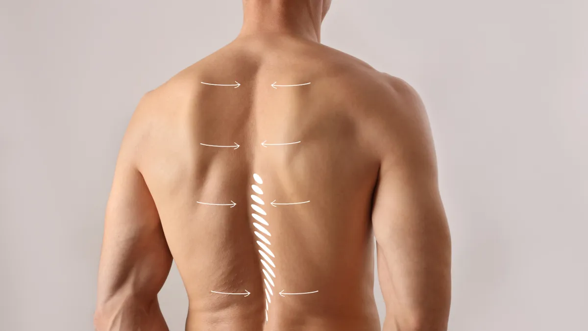 Spine surgeon Plano Texas for adolescent scoliosis correction