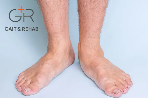 Pain and Flat Feet: What You Need to Know (and What to Do)