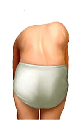 The Real Definition of Scoliosis