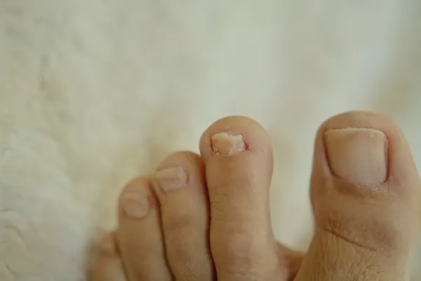 bad toe nails