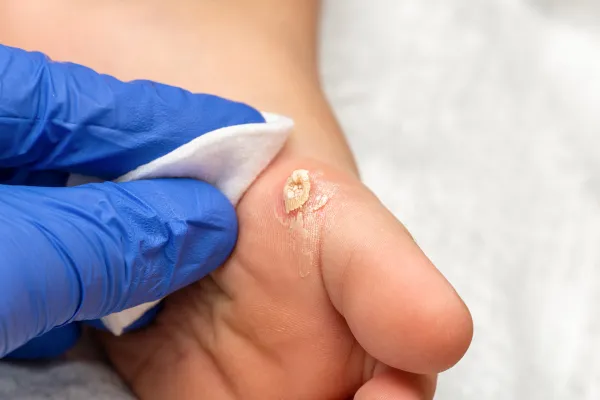 foot with corns