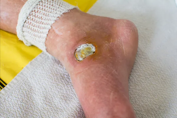 Neuropathic Ulcers