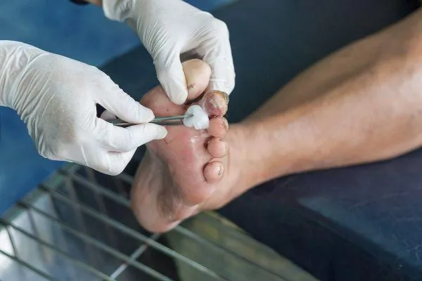 Hidden Danger of Neuropathic Ulcers: Early Signs You Shouldn’t Ignore