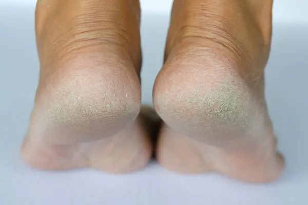 cracked feet peak podiatry