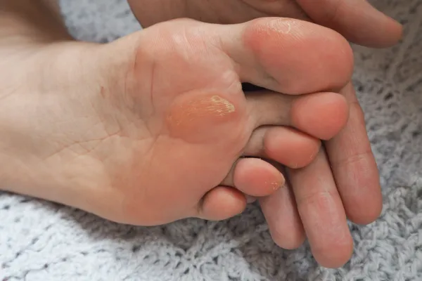 How to Tell if It’s a Corn, Callus or Verruca (And Why It Matters)