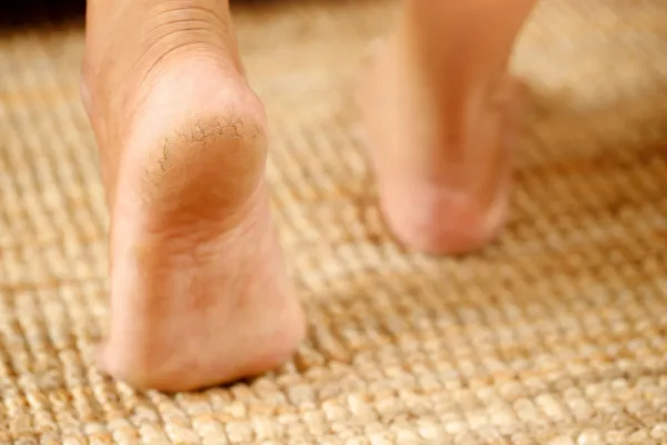 Cracked Heels and Dry Feet: Is It Just Cosmetic or a Sign of a Bigger Problem?