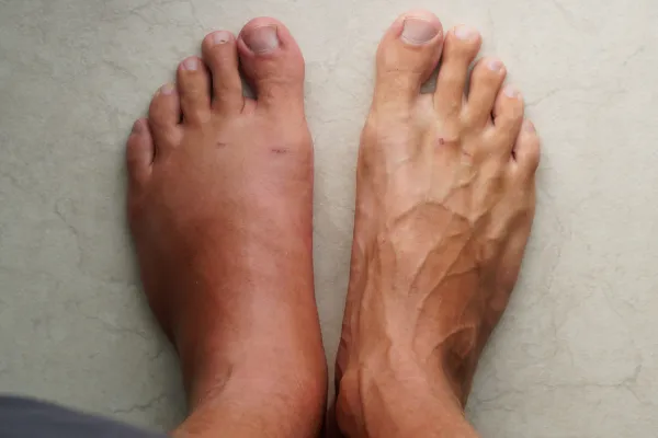 Why You Shouldn't Ignore Persistent Foot Swelling