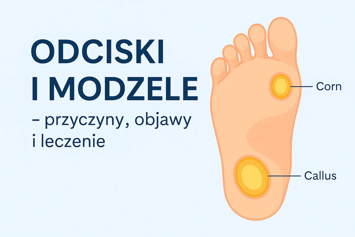 Odciski i modzele – przyczyny, objawy i leczenie | Podolog Płock
